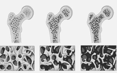 ¿Qué es la Osteoporosis? Prevención y tratamiento