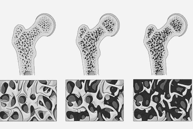 ¿Qué es la Osteoporosis? Prevención y tratamiento